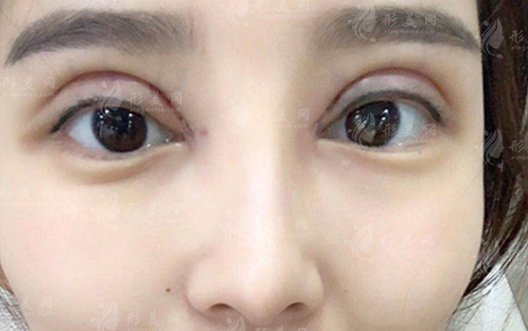 雙眼皮修復(fù)醫(yī)生排名前十：國內(nèi)眼修復(fù)口碑專家技術(shù)解析