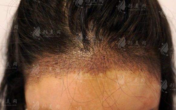 鄭州華仁植發(fā)醫(yī)院正規(guī)嗎?劉裴華院長(zhǎng)20年經(jīng)驗(yàn)，毛囊成活率超高