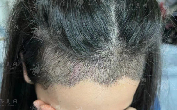 2026國內(nèi)植發(fā)價(jià)格表：?jiǎn)蚊?-20元/發(fā)際線1-3萬全解析