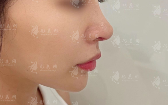 國產(chǎn)萬春膨體怎么樣?臻挺臻美兩大系列隆鼻下巴型號價格解析