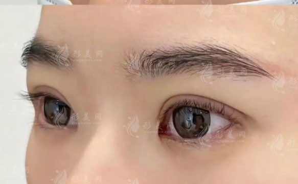 上海鄭小紅雙眼皮修復怎么樣?20年經(jīng)驗閉眼無痕技術(shù)價格8000起