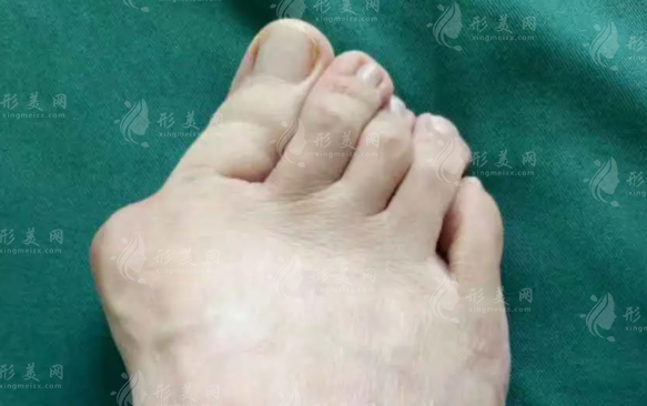 溫建民微創(chuàng)治大腳骨靠譜嗎？術(shù)后效果與費(fèi)用詳解