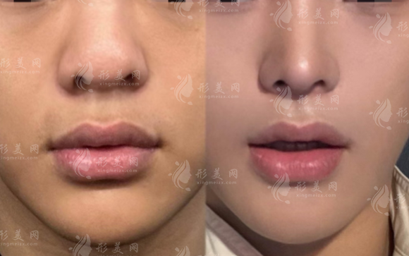 朱剛強鼻整形技術(shù)怎么樣？20年經(jīng)驗醫(yī)生實力揭秘