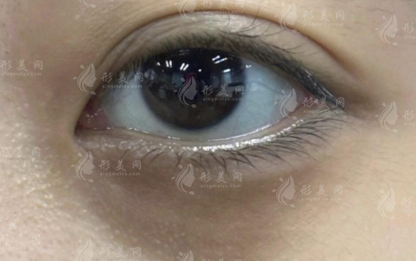 玻尿酸去黑眼圈有效嗎？原理、維持時間和價格解析