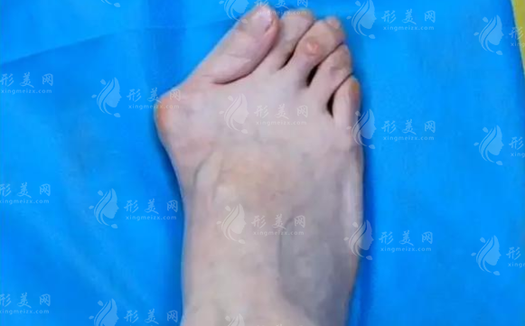 2026蘇敬達微創(chuàng)大腳骨價格曝光，北京圣嘉新親診預(yù)約攻略