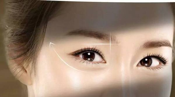 重瞼修復(fù)術(shù)的恢復(fù)時(shí)間要多久