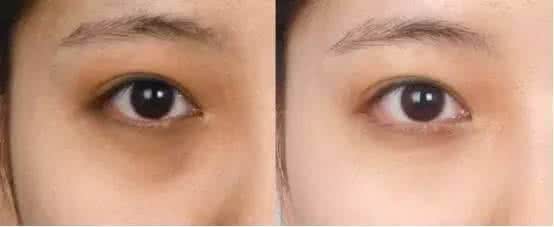 激光去黑眼圈有沒有效果呢