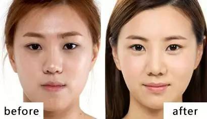 臥蠶整形手術(shù)大概多少錢