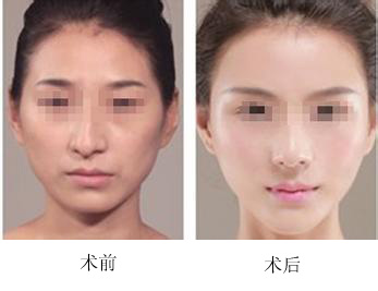 鼻子歪了怎么矯正呢