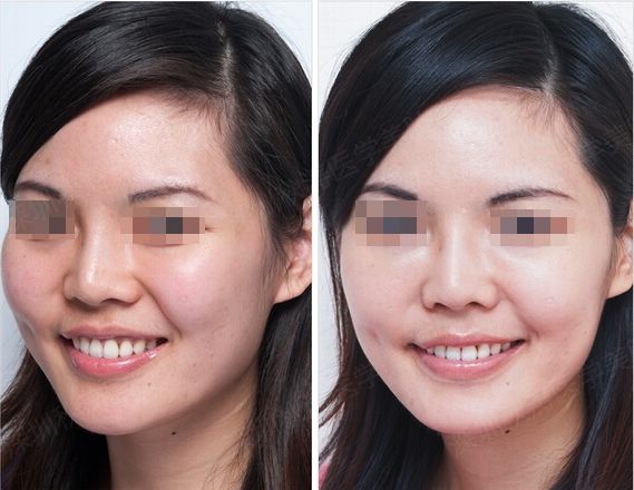 打美白針有沒有什么危害呢