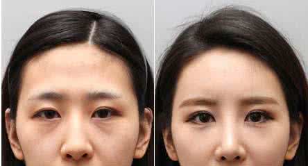 注射玻尿酸可以馬上洗澡嗎