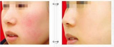 怎么去除紅血絲呢