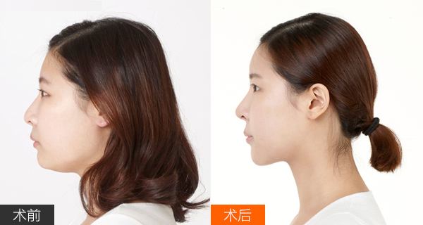 改臉型的手術(shù)方式有哪些呢