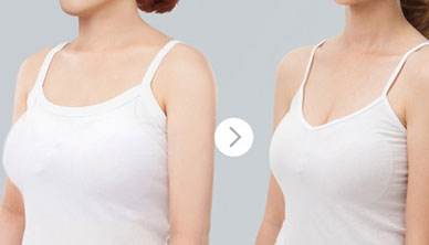 巨乳縮小的費用是多少