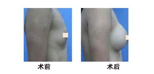 乳房再造手術(shù)費(fèi)用是多少