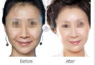 激光除皺一般能維持多久呢