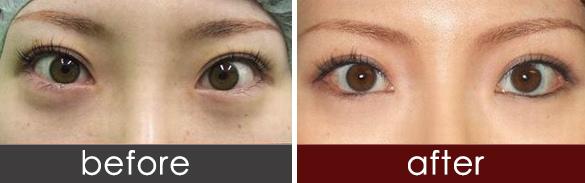 開外眼角術(shù)后有哪些注意事項(xiàng)