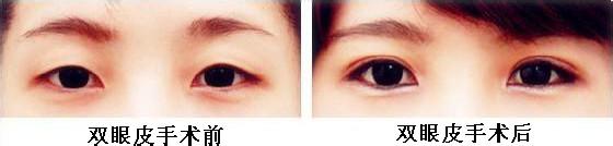 埋線雙眼皮價(jià)格是多少