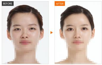 歐式雙眼皮對(duì)比照