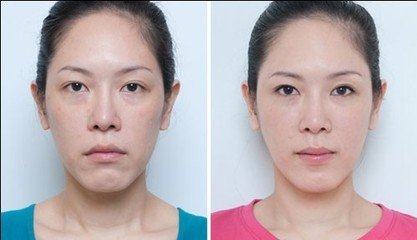 去眼袋手術(shù)禁忌癥