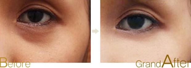 激光祛黑眼圈有哪些優(yōu)勢