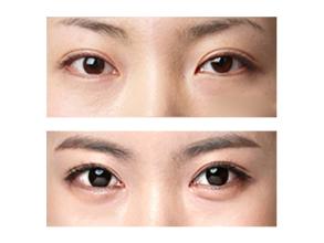 臥蠶整形方式有哪些