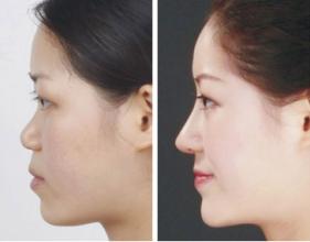 隆鼻手術(shù)有哪些注意事項(xiàng)