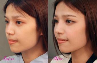 隆鼻費(fèi)用是多少