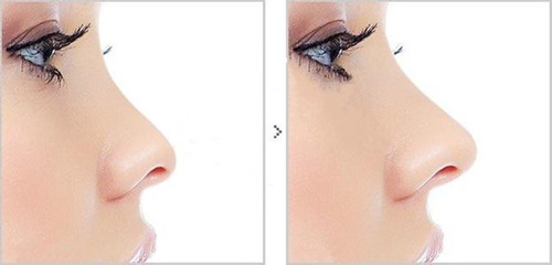 鼻尖整形注意事項(xiàng)