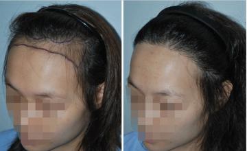 發(fā)際線種植術后效果好嗎