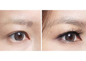 毛發(fā)移植適應人群