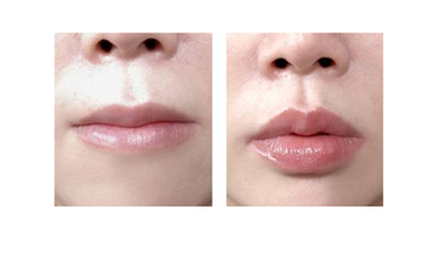 豐唇方法有哪些