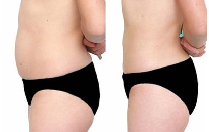 吸脂減肥有哪些并發(fā)癥