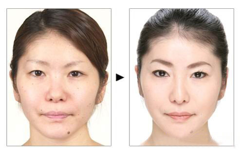 隆鼻價(jià)格一般是多少