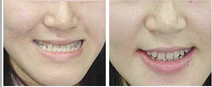 地包天矯正最佳時間