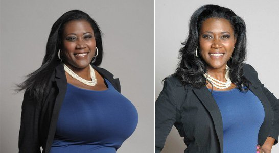 巨乳縮小安全性