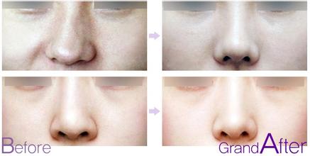 鼻子失敗修復(fù)術(shù)后護理