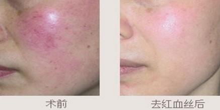激光去紅血絲對比照