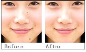 激光去痣有哪些優(yōu)勢