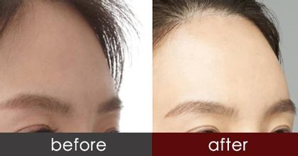 自體脂肪豐額頭效果如何