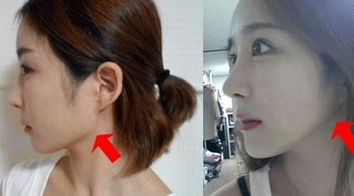 下頜角價(jià)格是多少