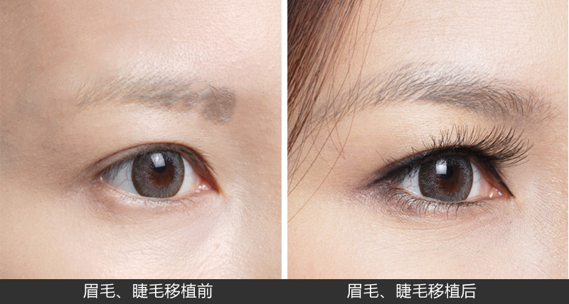 眉毛種植有哪些常識