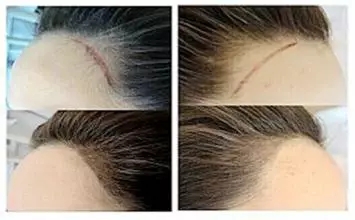 種植發(fā)際線價格因素