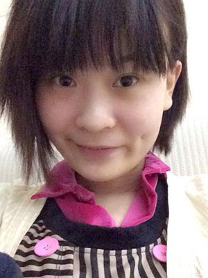 酒窩成形術(shù)對(duì)比照 打造甜美系女生