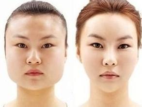磨骨手術(shù)對(duì)比照 打造精致小臉