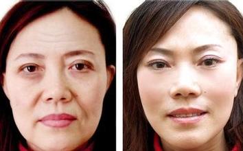 激光祛皺對(duì)比圖