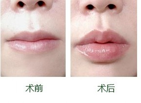 玻尿酸豐唇對比圖