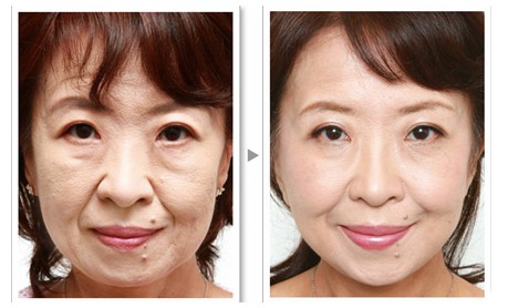 電波拉皮有不良反應(yīng)嗎