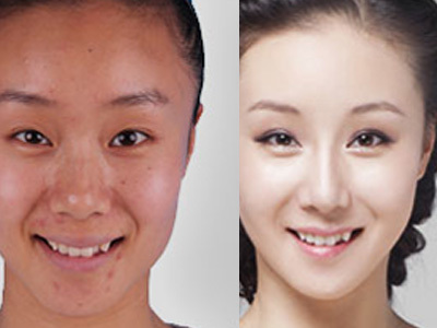 鼻翼縮小禁忌癥