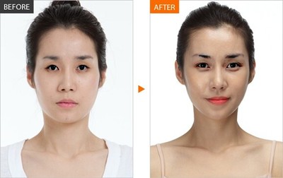 自體脂肪豐額有風(fēng)險(xiǎn)嗎